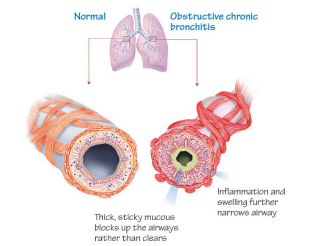 diagram comparing normal airways and airways inflamed due to COPD 