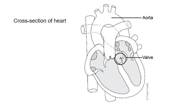 TAVI cross section of heart